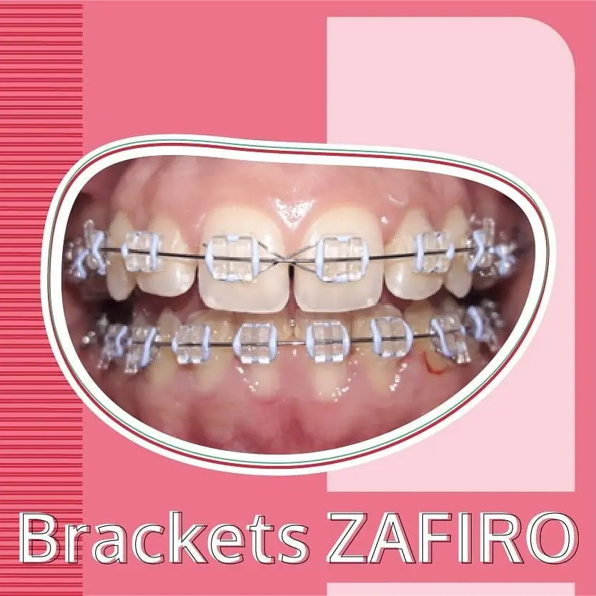 Brackets de Zafiro