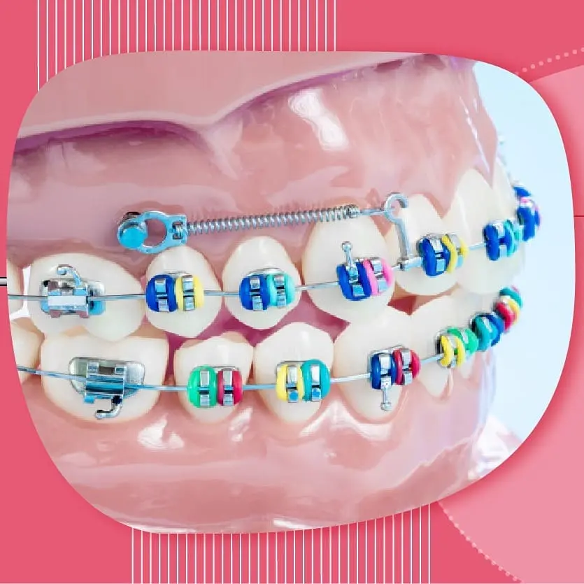 Resultado de tratamiento con brackets