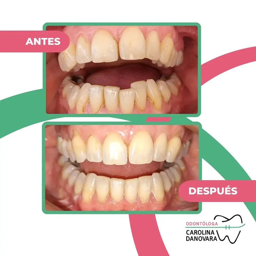 Caso antes y después con brackets - Adulto