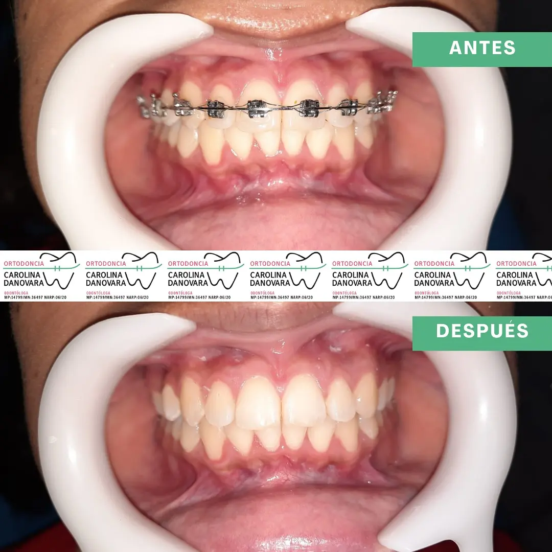 Caso antes y después con brackets - Niño