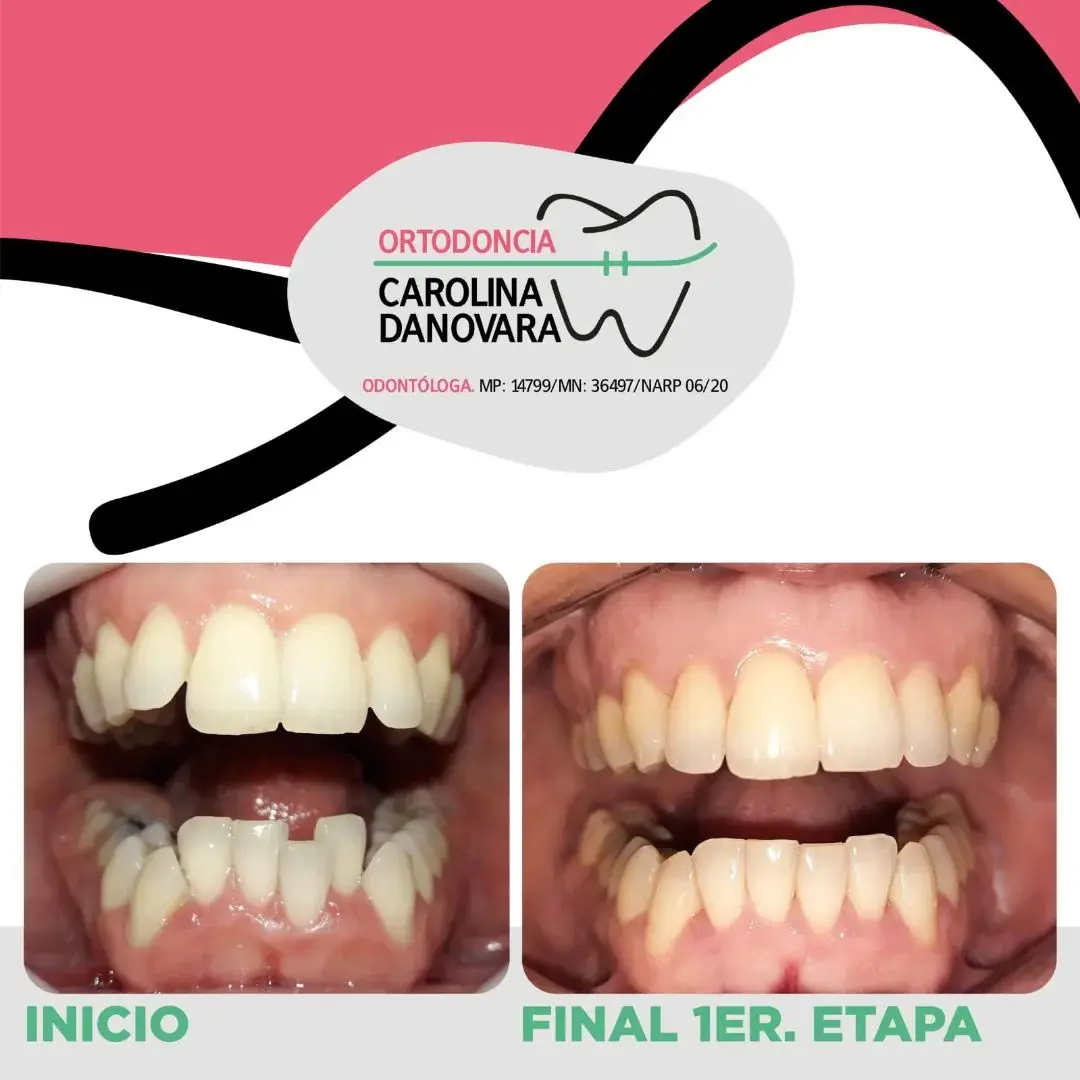 Caso antes y después con alineadores - Adulto